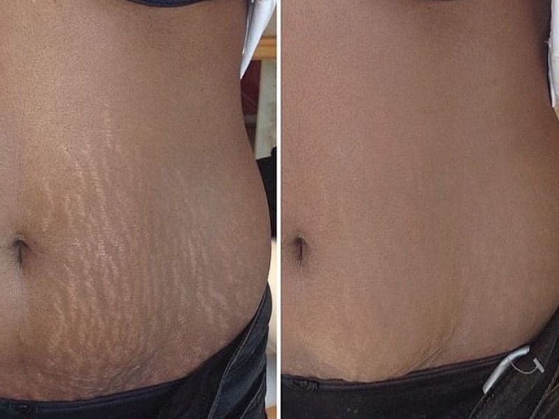 Stretch Mark & Acne Camouflage - Paramedical Academy Online Course